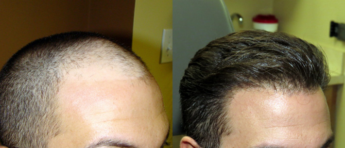 regrow your hair follicles